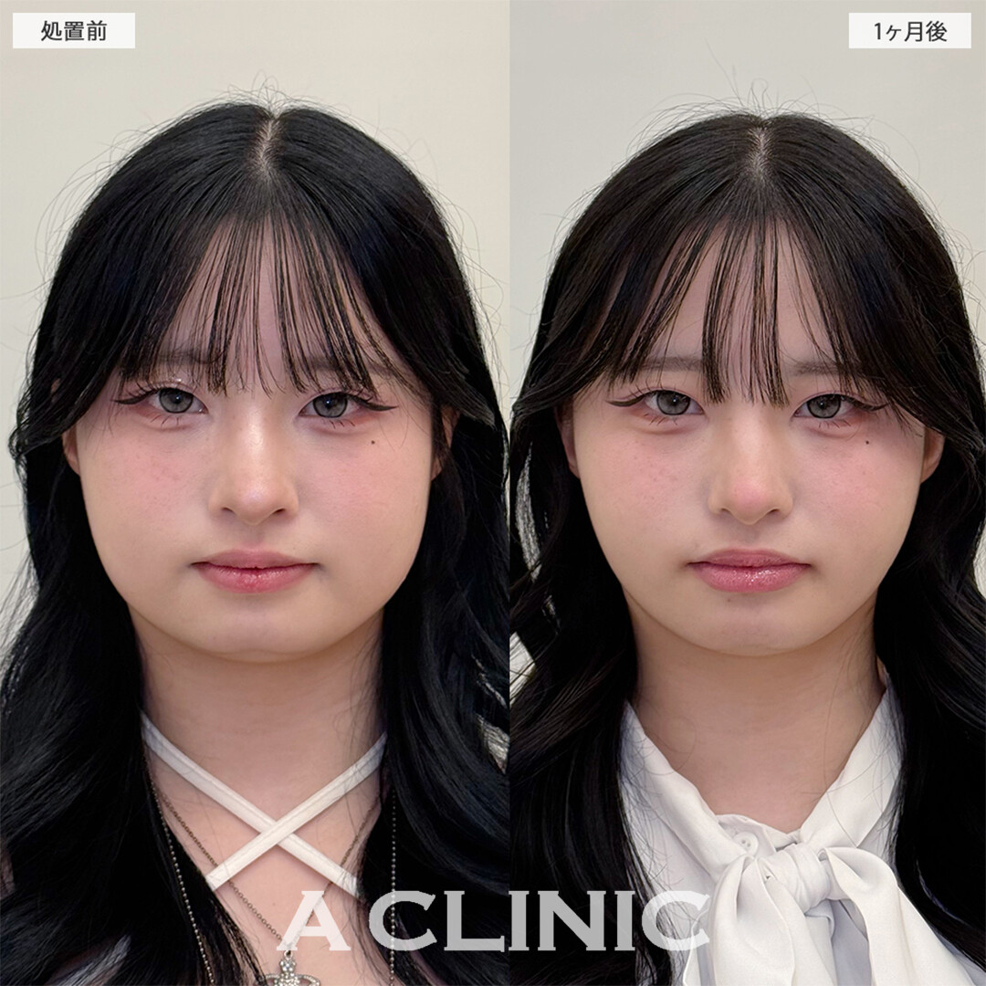 1day小顔脂肪吸引と小顔エラボトックスで下膨れ顔解消しました！こちら処置前と1ヶ月後の症例です(20代女性)