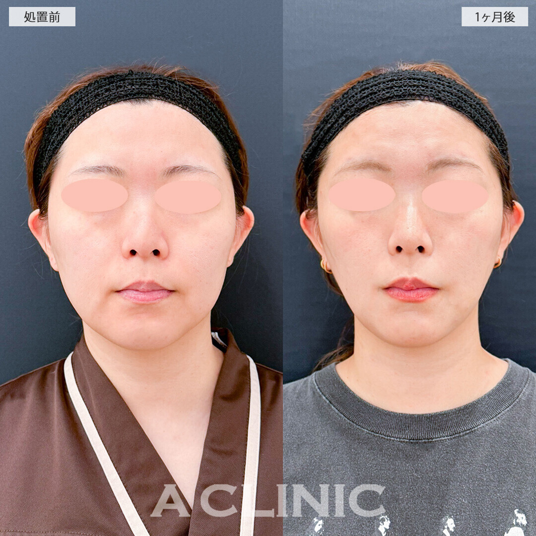 1day小顔脂肪吸引と小顔エラボトックスで余白が減り全体的にスッキリした印象に！処置前から2ヶ月後の症例です(30代女性)