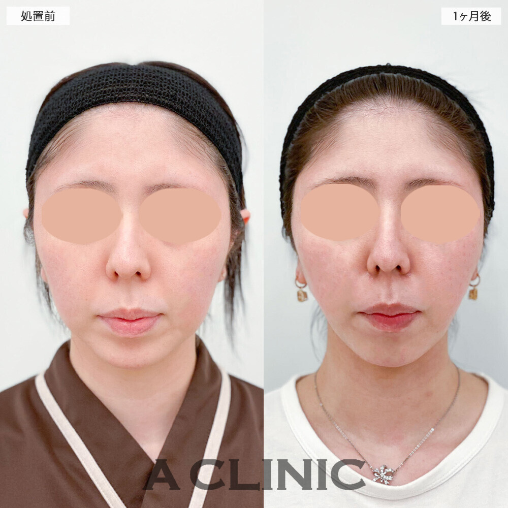 1day小顔脂肪吸引で加工無しでもVフェイスに！こちら処置前から2ヶ月2週間後の症例です(20代女性)
