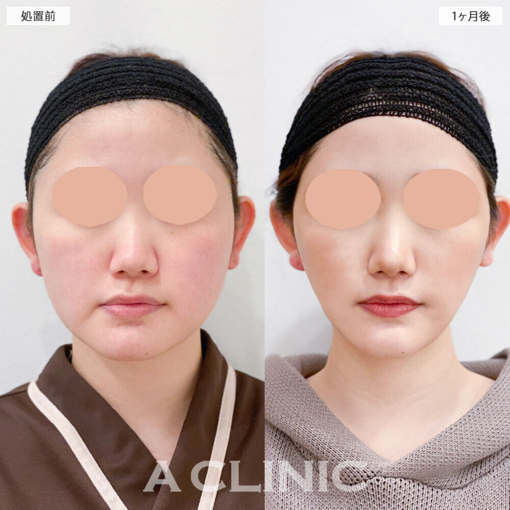 1day小顔脂肪吸引で輪郭がしっかり出ました！こちら処置前と1ヶ月後の症例です(20代女性)