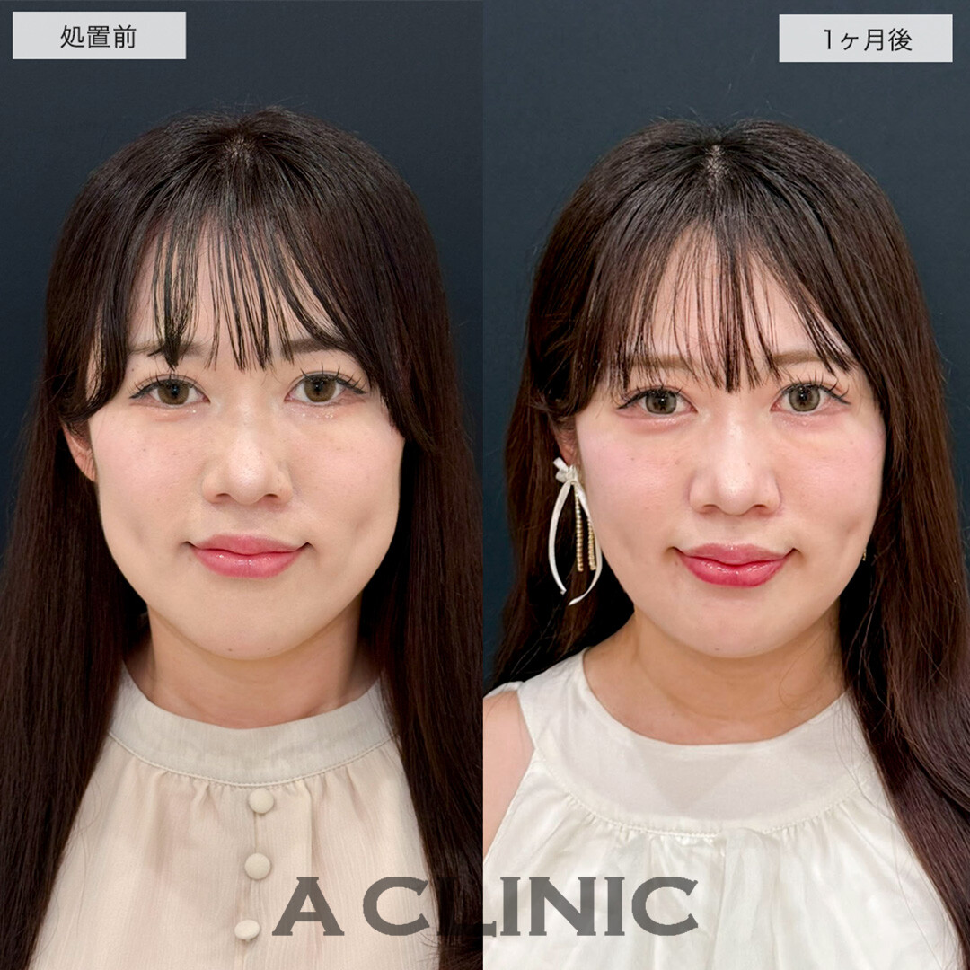 1day小顔脂肪吸引で下膨れ顔が改善し洗練された美人に!こちら処置前と1ヶ月後の症例です(30代女性)