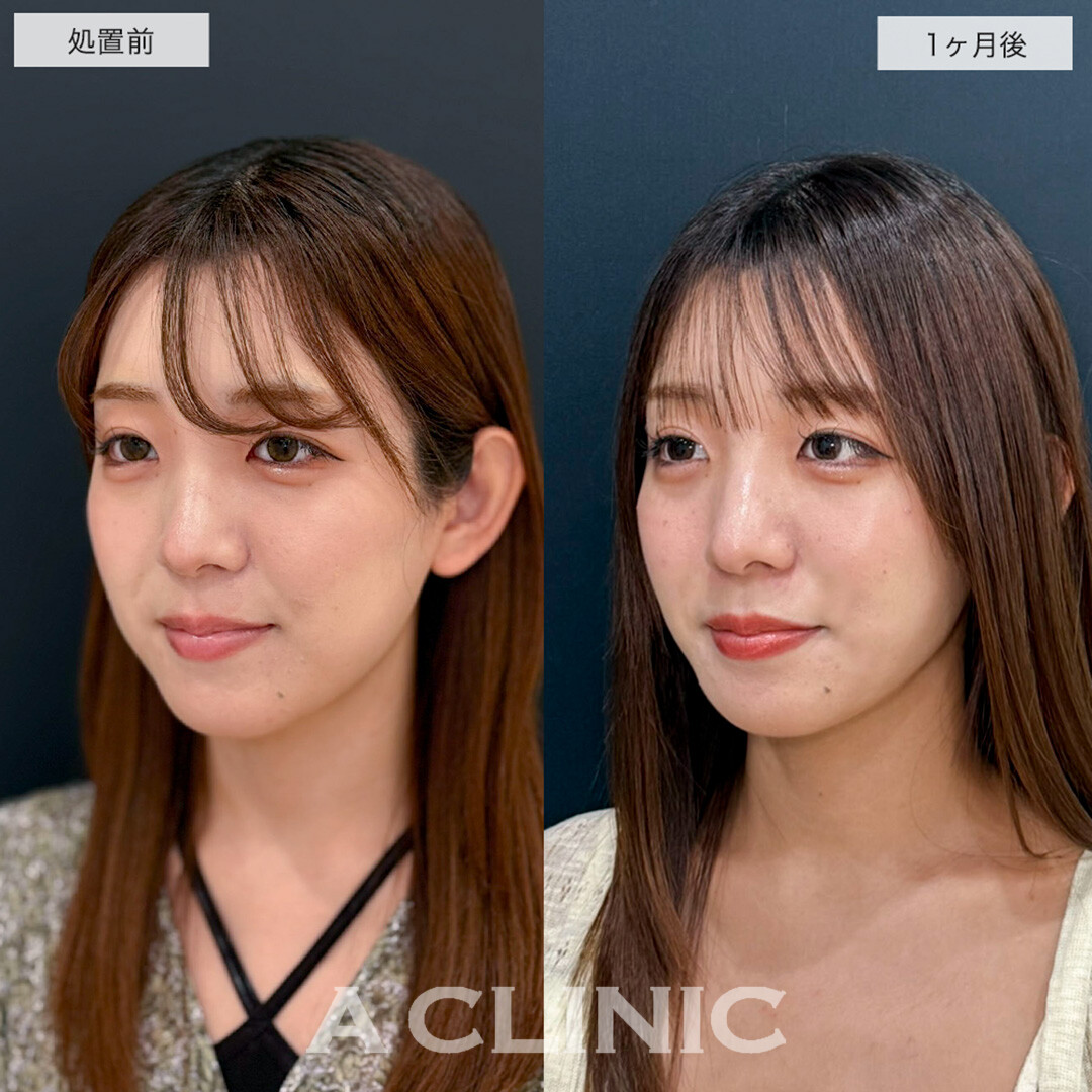 1day小顔脂肪吸引でリバウンドしない半永久の理想の輪郭に!こちら処置前と1ヶ月後の症例です(20代女性)