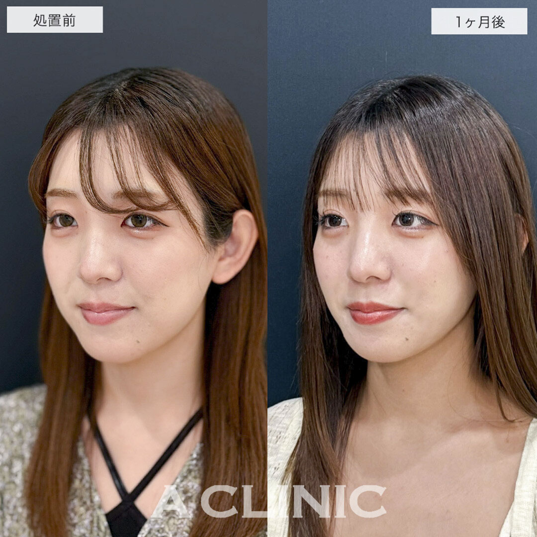 1day小顔脂肪吸引でリバウンドしない半永久の理想の輪郭に!こちら処置前と1ヶ月後の症例です(20代女性)