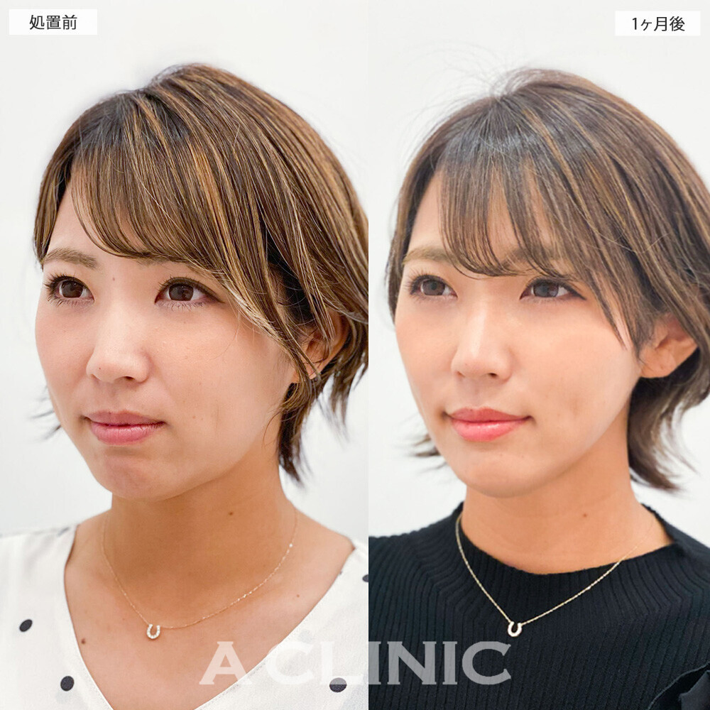 1day小顔脂肪吸引で重たく見えていた顔がスッキリ改善！こちら処置前から2ヶ月後の症例です(30代女性)