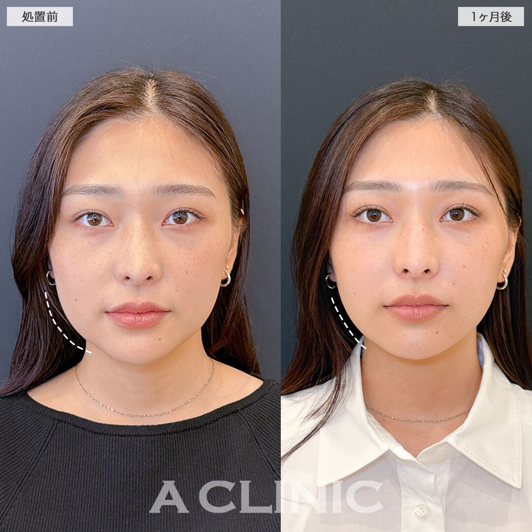 1day小顔脂肪吸引で顔の余白を軽減し理想の小顔に！こちら処置前と1ヶ月後の症例です(20代女性)