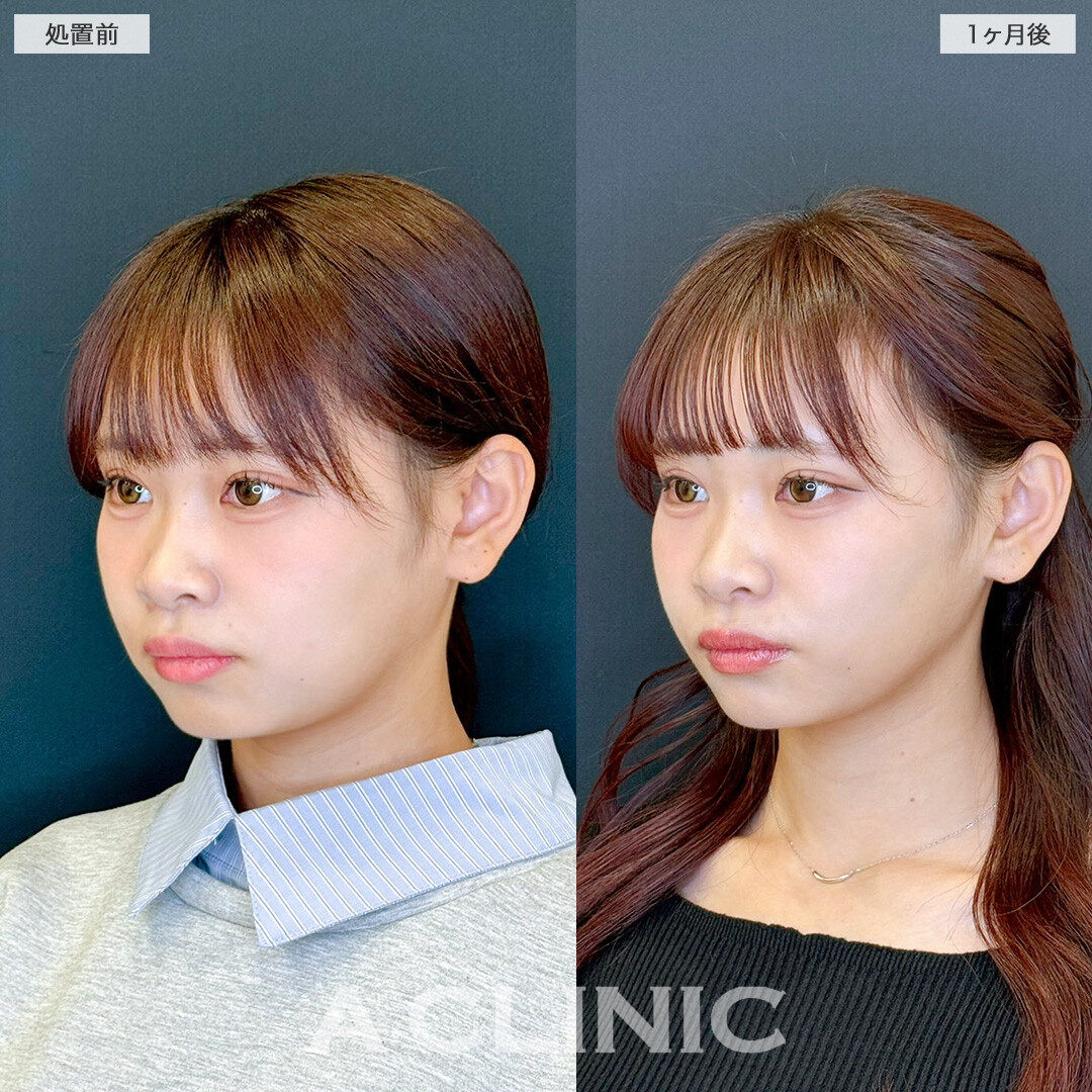 1day小顔脂肪吸引で頬の位置が上がって小顔に！処置前と1ヶ月後の症例です(20代女性)
