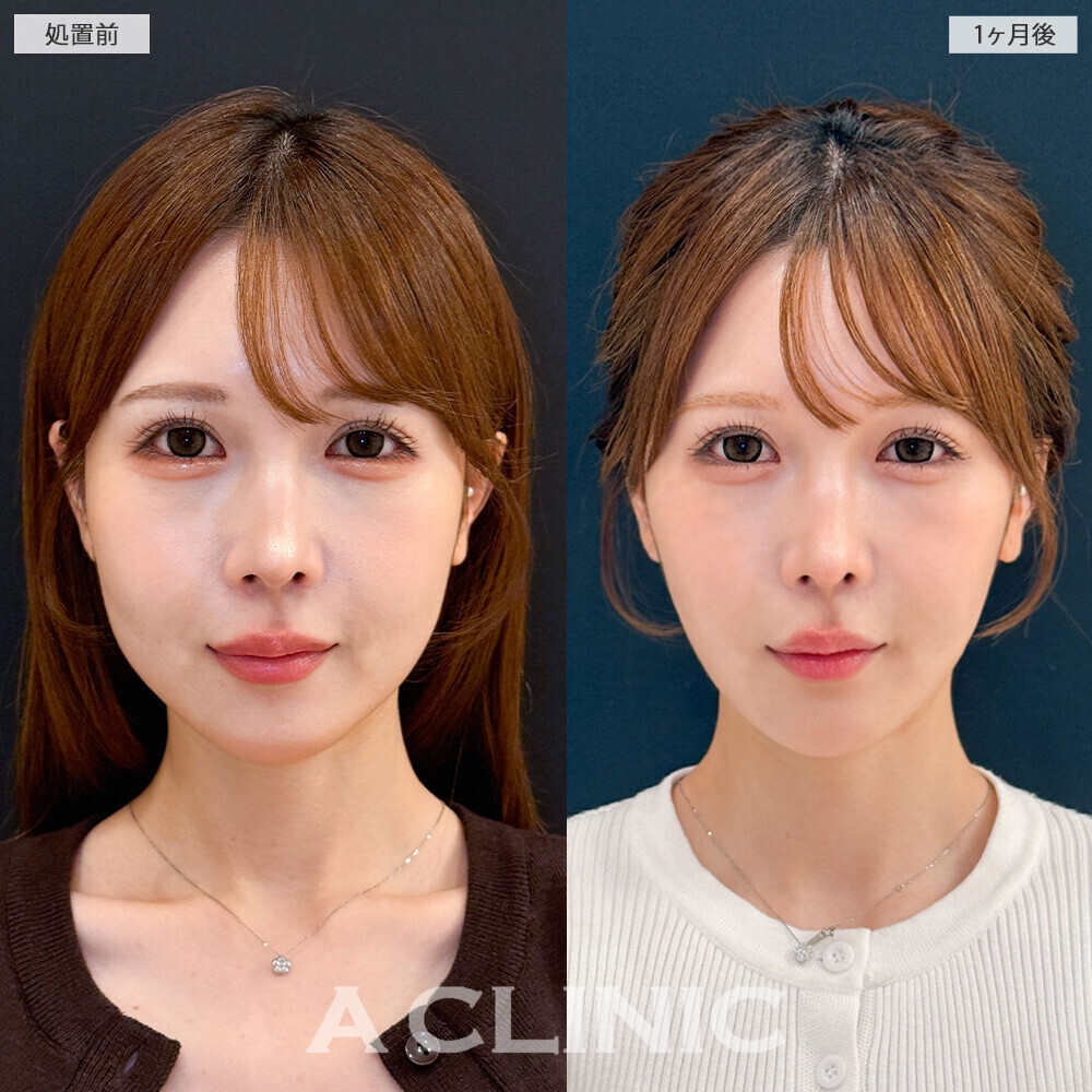 1day小顔脂肪吸引で頬のぷくっと感がなくなり卵型の輪郭に！こちら処置前から1ヶ月後の症例です(20代女性)