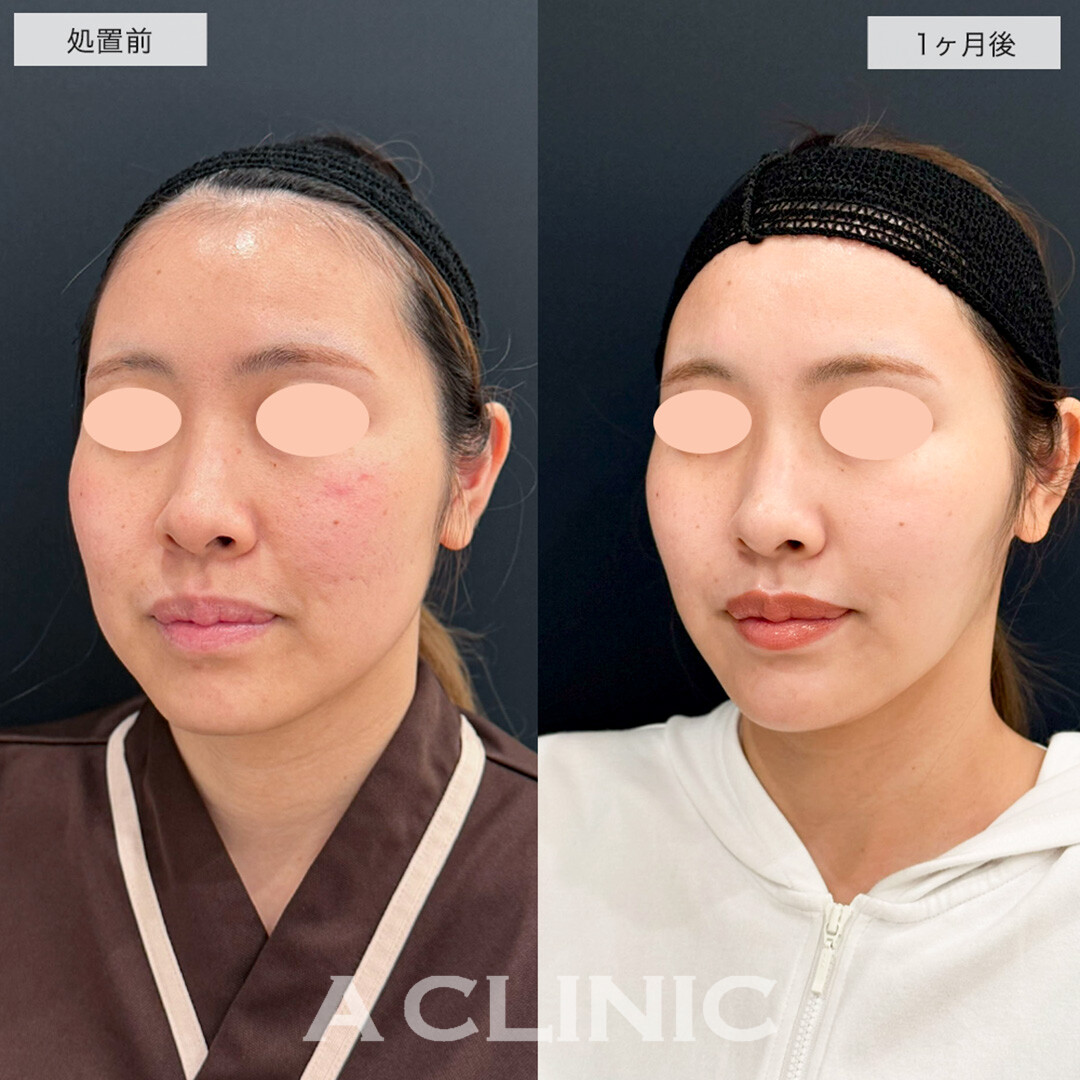 1day小顔脂肪吸引で憧れのインフルエンサーのような輪郭に!こちら処置前と1ヶ月後の症例です(30代女性)