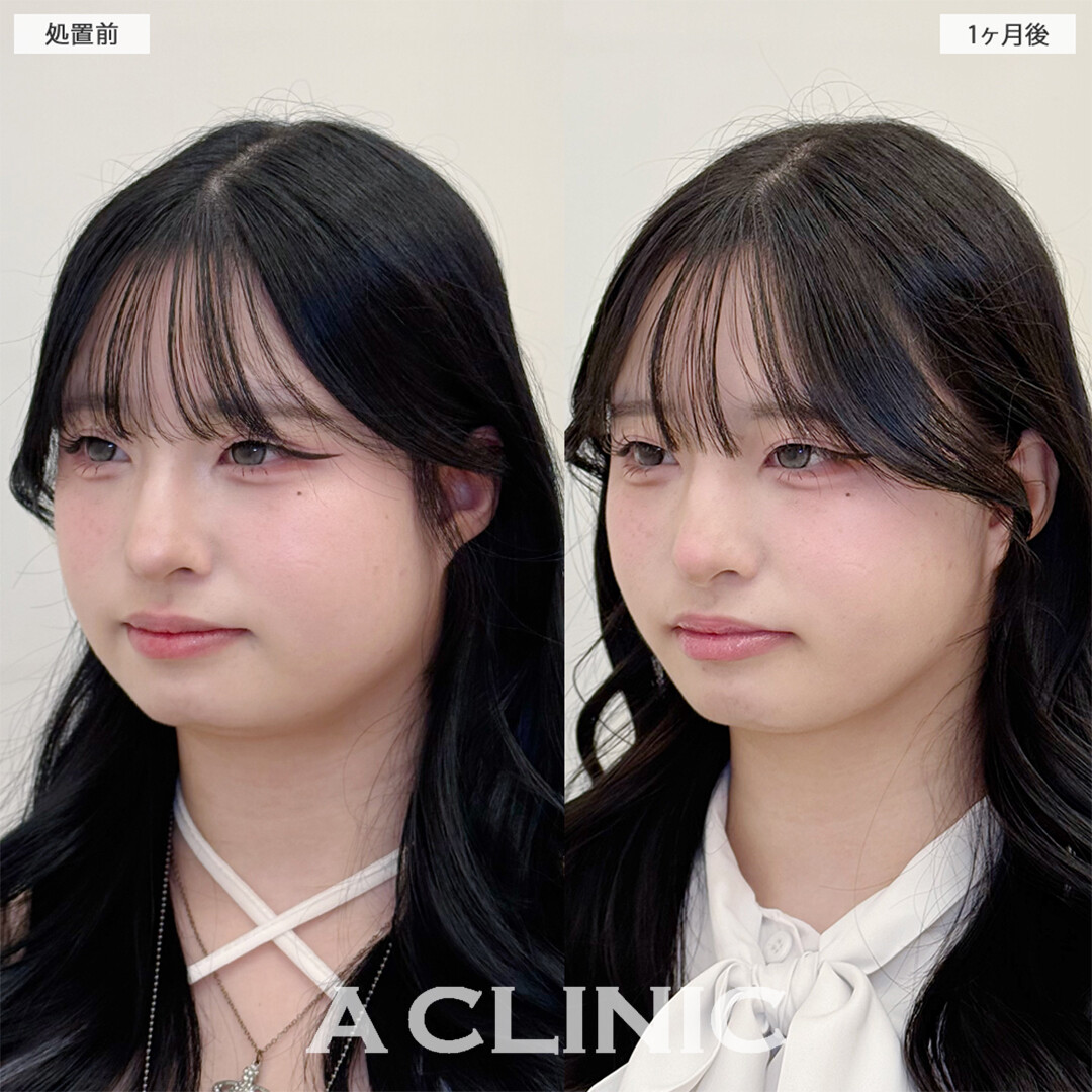 1day小顔脂肪吸引と小顔エラボトックスで下膨れ顔解消しました！こちら処置前と1ヶ月後の症例です(20代女性)