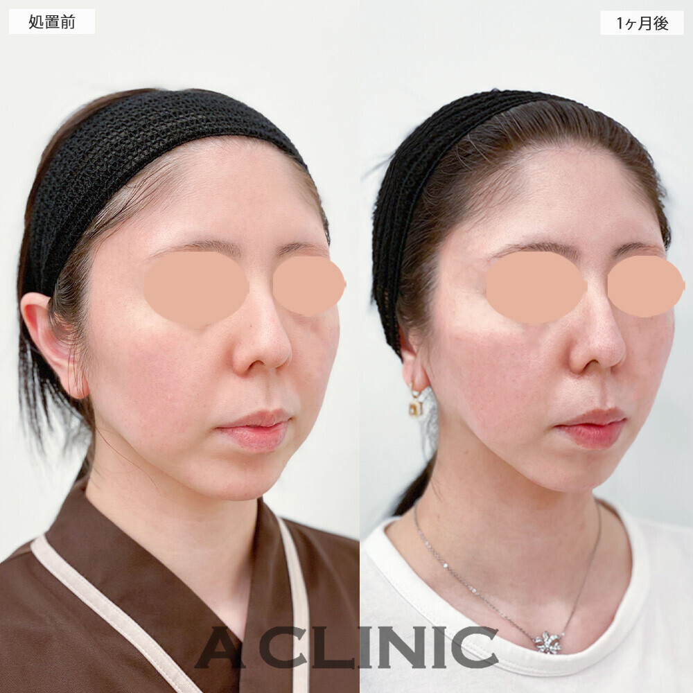 1day小顔脂肪吸引で加工無しでもVフェイスに！こちら処置前から2ヶ月2週間後の症例です(20代女性)
