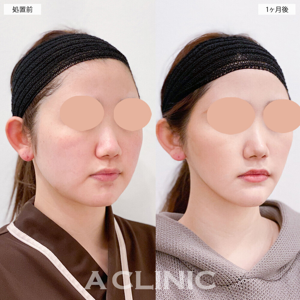 1day小顔脂肪吸引で輪郭がしっかり出ました！こちら処置前と1ヶ月後の症例です(20代女性)