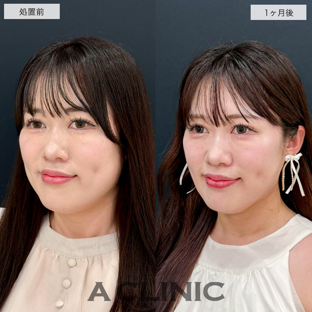 1day小顔脂肪吸引で下膨れ顔が改善し洗練された美人に!こちら処置前と1ヶ月後の症例です(30代女性)