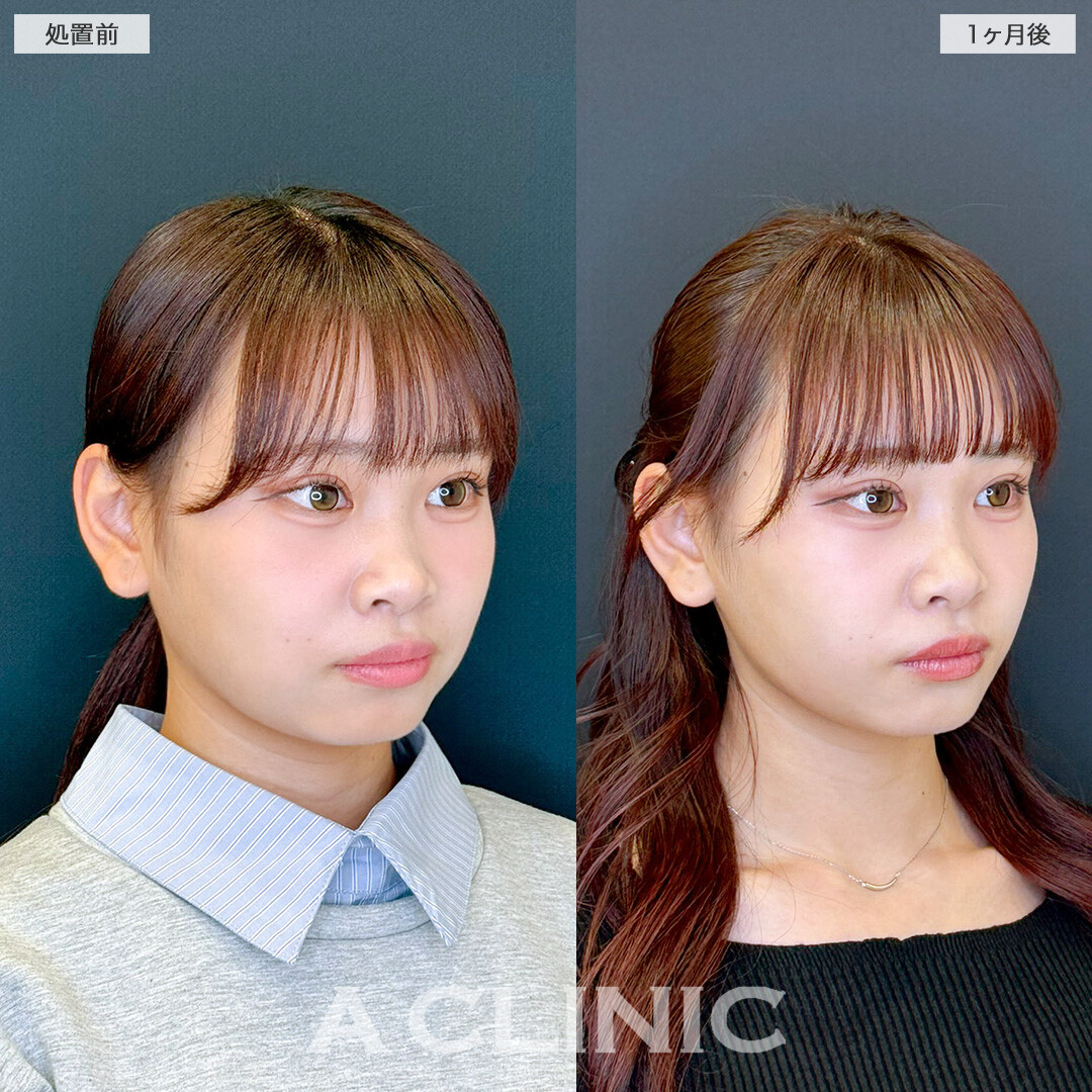 1day小顔脂肪吸引で頬の位置が上がって小顔に！処置前と1ヶ月後の症例です(20代女性)
