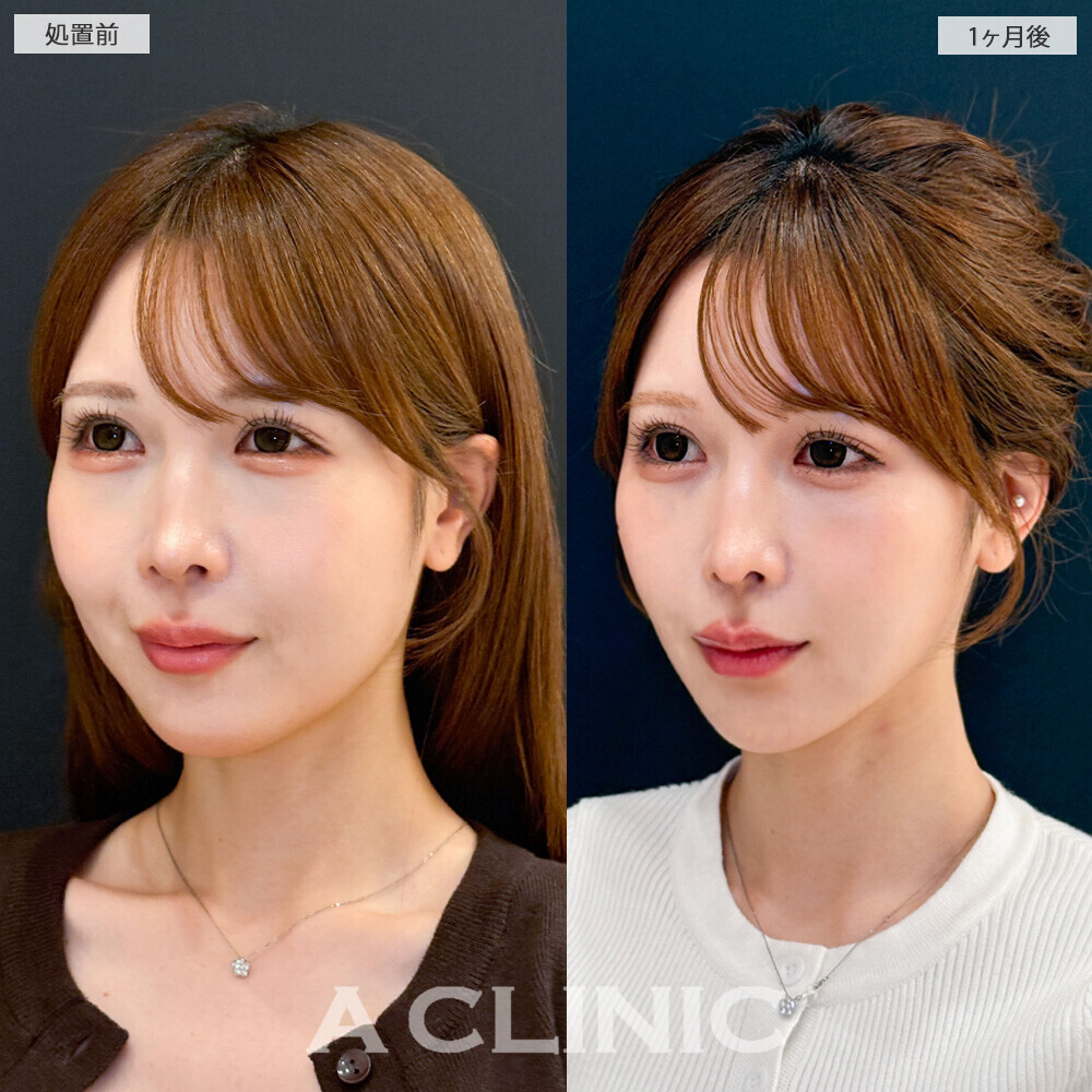 1day小顔脂肪吸引で頬のぷくっと感がなくなり卵型の輪郭に！こちら処置前から1ヶ月後の症例です(20代女性)