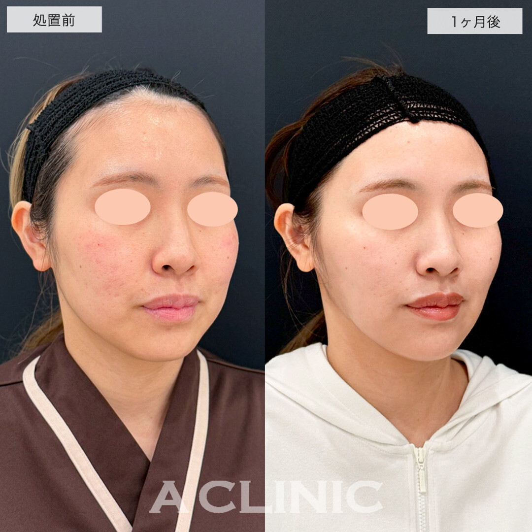 1day小顔脂肪吸引で憧れのインフルエンサーのような輪郭に!こちら処置前と1ヶ月後の症例です(30代女性)