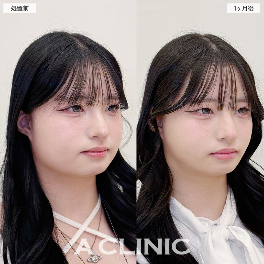 1day小顔脂肪吸引と小顔エラボトックスで下膨れ顔解消しました！こちら処置前と1ヶ月後の症例です(20代女性)