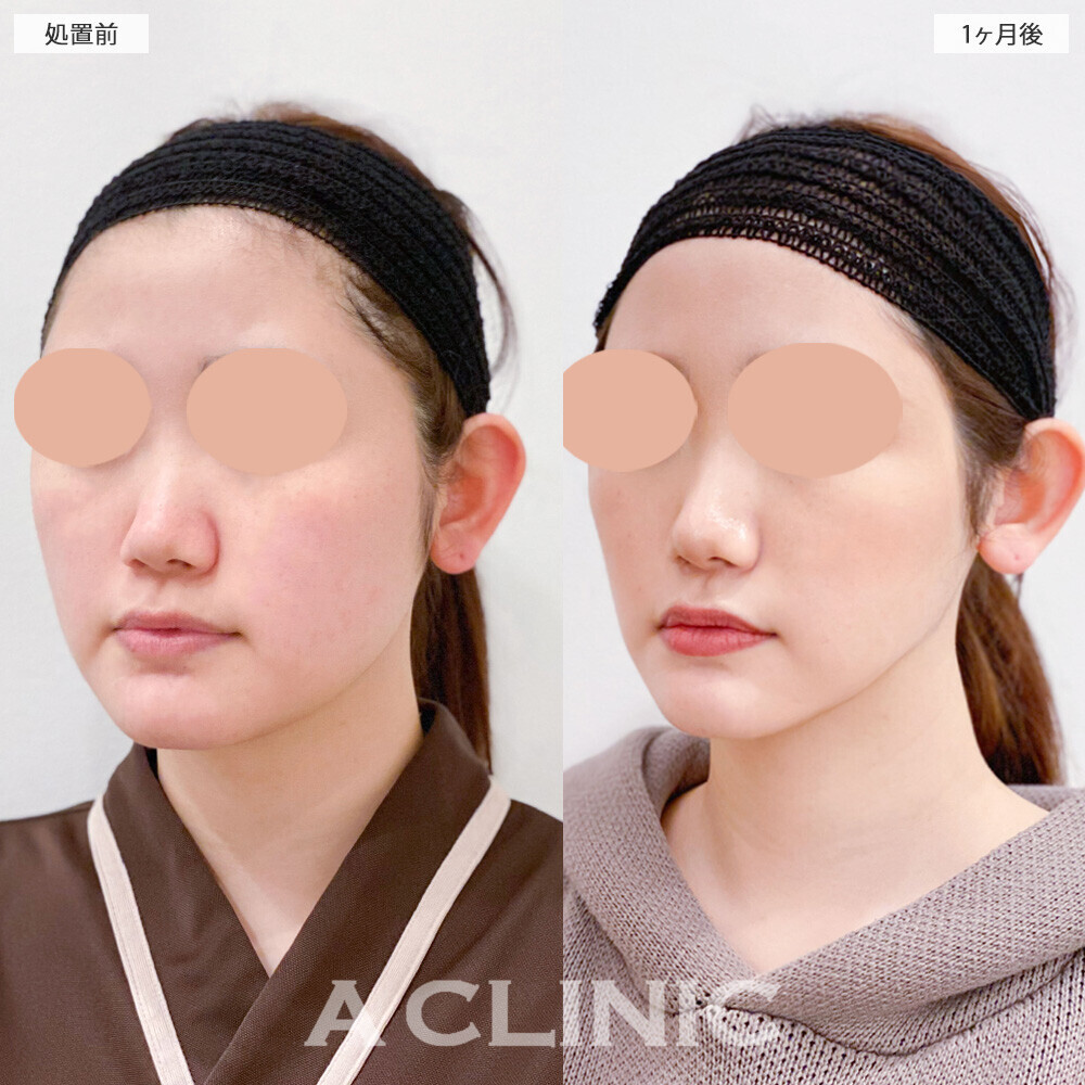 1day小顔脂肪吸引で輪郭がしっかり出ました！こちら処置前と1ヶ月後の症例です(20代女性)
