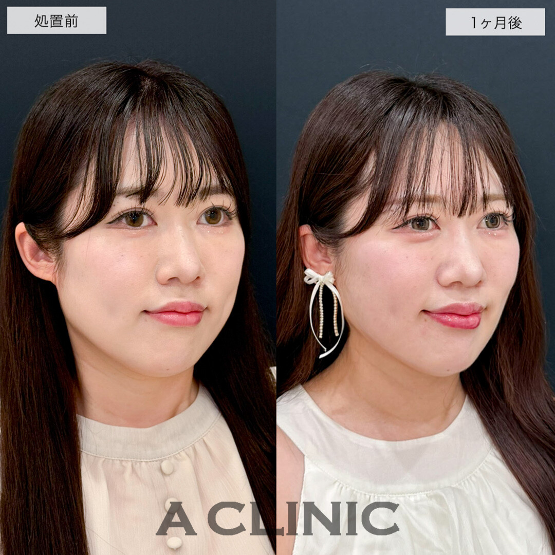 1day小顔脂肪吸引で下膨れ顔が改善し洗練された美人に!こちら処置前と1ヶ月後の症例です(30代女性)