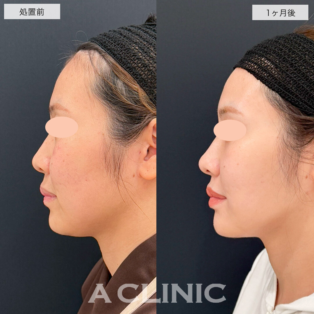 1day小顔脂肪吸引で憧れのインフルエンサーのような輪郭に!こちら処置前と1ヶ月後の症例です(30代女性)