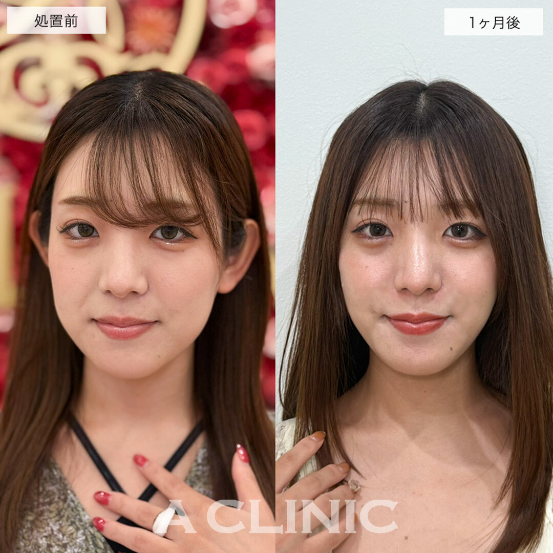 1day小顔脂肪吸引でリバウンドしない半永久の理想の輪郭に!こちら処置前と1ヶ月後の症例です(20代女性)