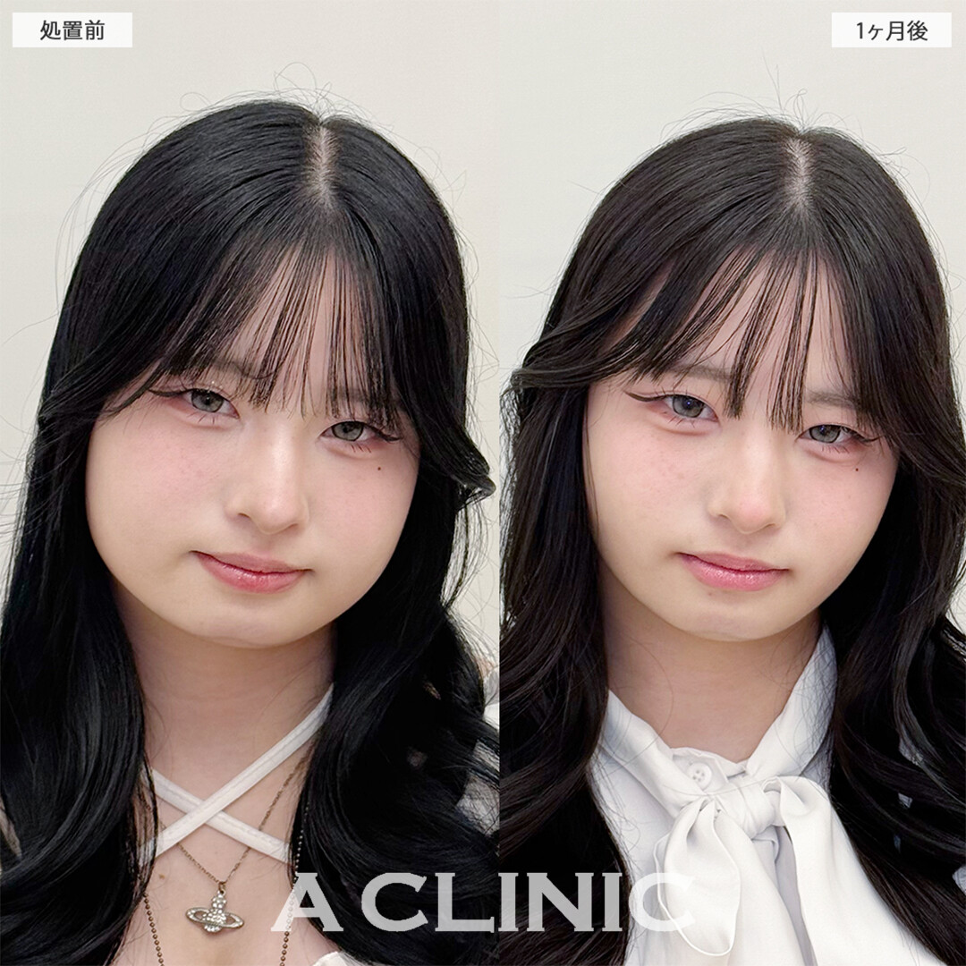 1day小顔脂肪吸引と小顔エラボトックスで下膨れ顔解消しました！こちら処置前と1ヶ月後の症例です(20代女性)