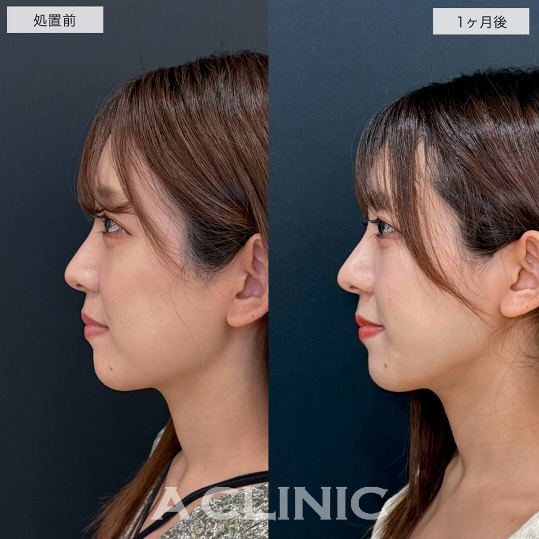 1day小顔脂肪吸引でリバウンドしない半永久の理想の輪郭に!こちら処置前と1ヶ月後の症例です(20代女性)