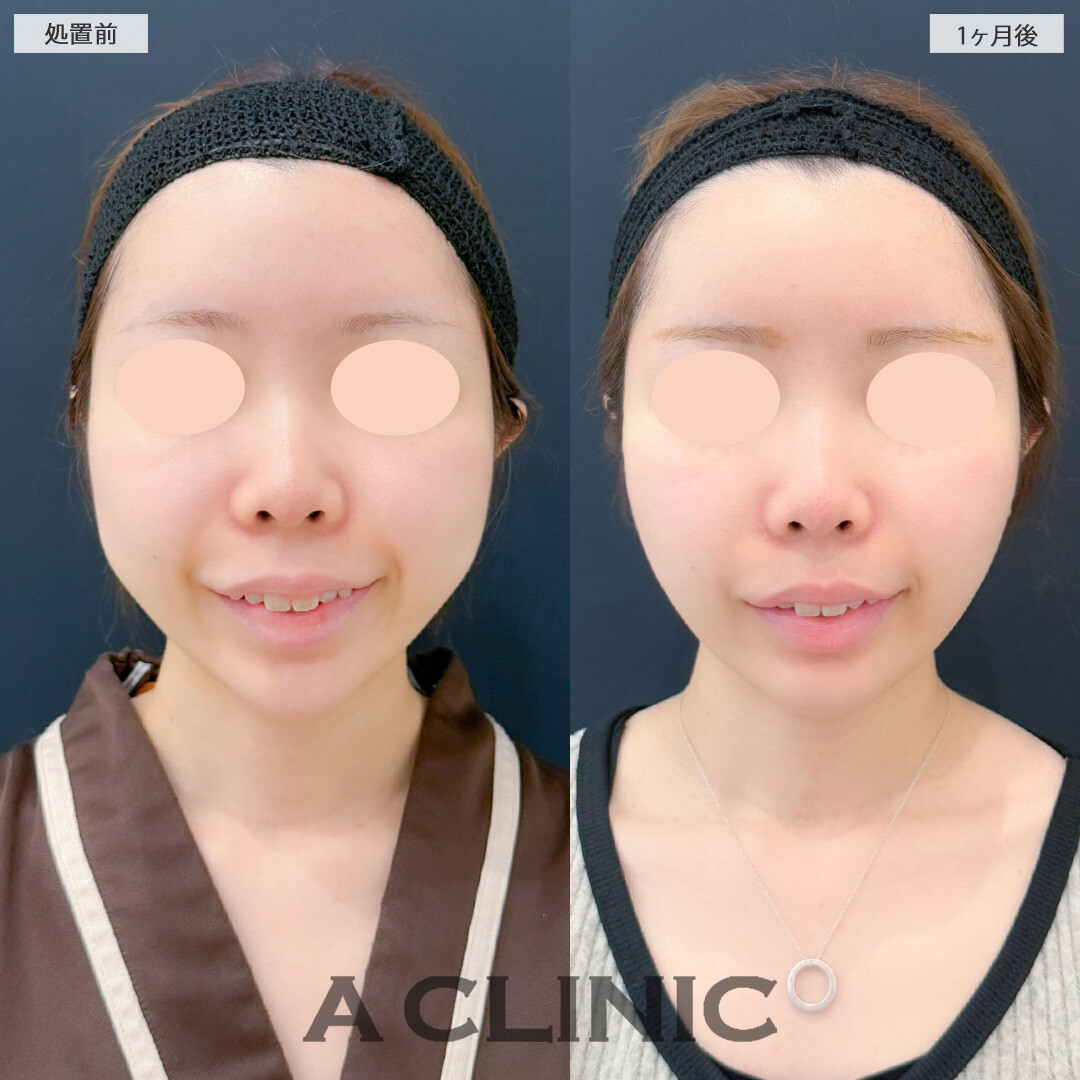 1day小顔脂肪吸引とバッカルファット除去術と小顔エラボトックスで笑った時の膨らみを解消！こちら処置前と1ヶ月後の症例です(20代女性)