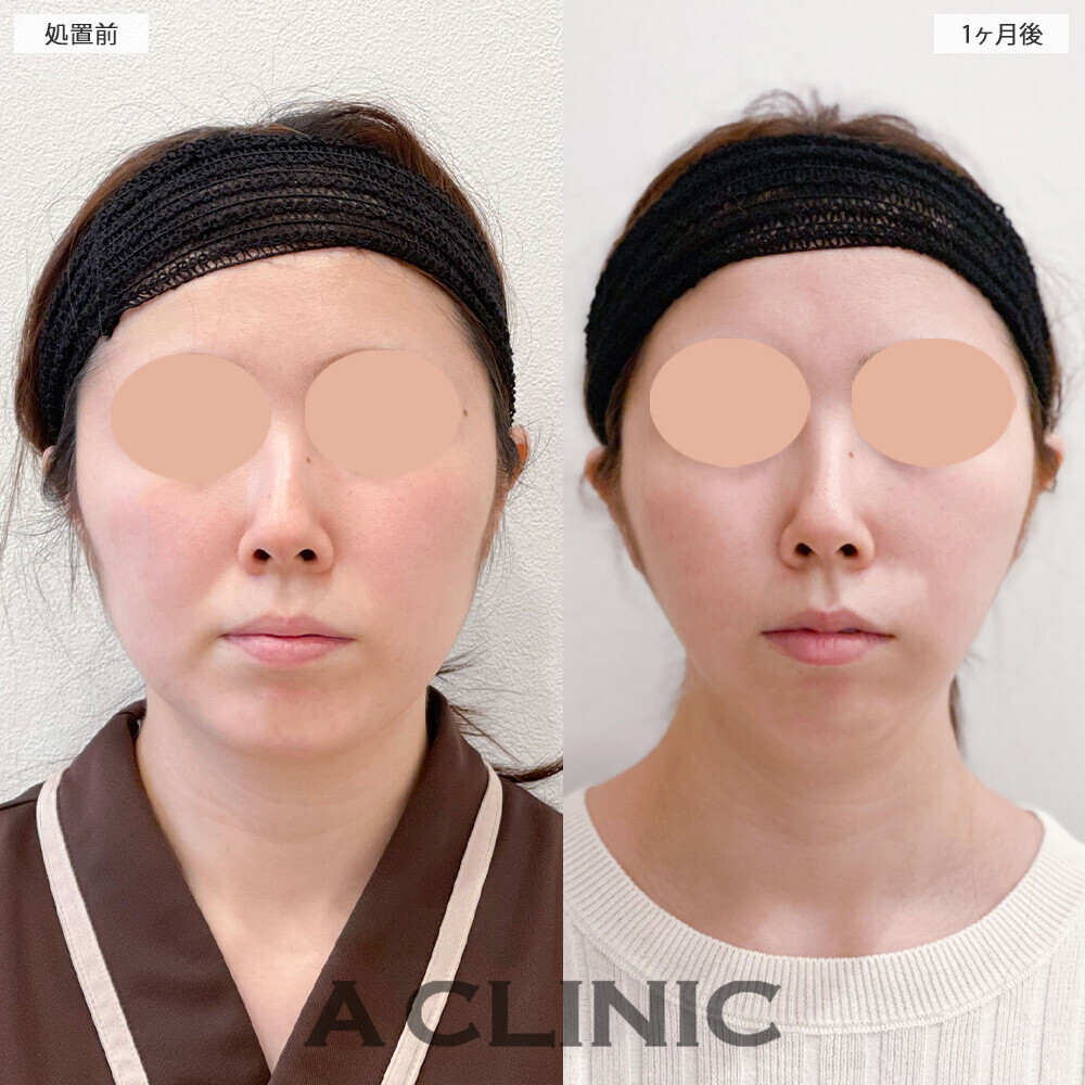 1day小顔脂肪吸引でVフェイスになりました！処置前と1ヶ月後の症例です(20代女性)