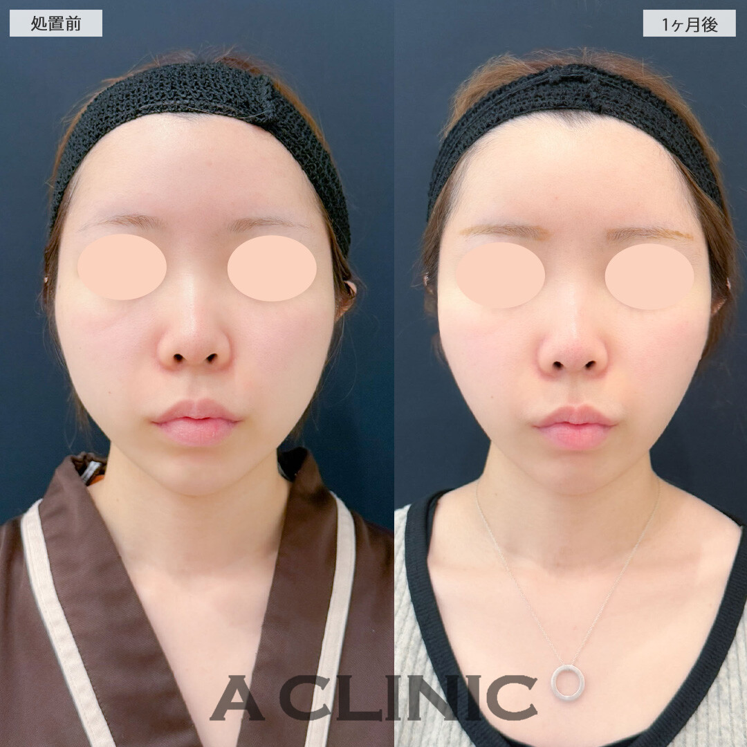1day小顔脂肪吸引とバッカルファット除去術と小顔エラボトックスで笑った時の膨らみを解消！こちら処置前と1ヶ月後の症例です(20代女性)