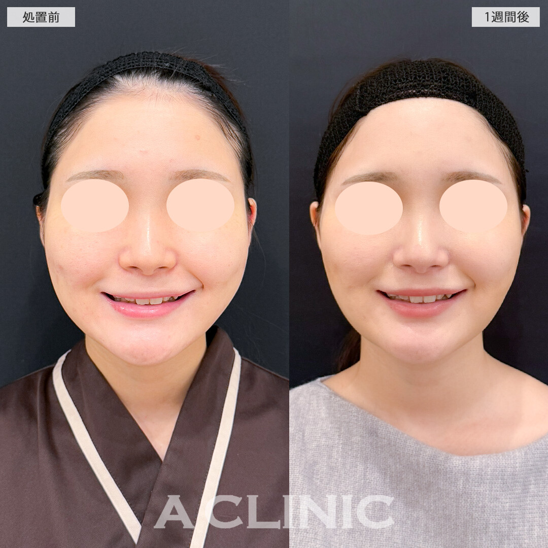 1day小顔脂肪吸引とバッカルファット除去術は1週間後でもほとんどダウンタイムが気になりません！処置前と1週間後の症例です(20代女性)