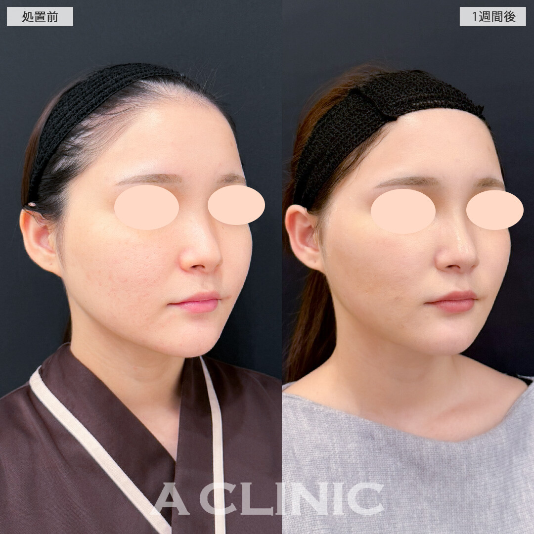 1day小顔脂肪吸引とバッカルファット除去術は1週間後でもほとんどダウンタイムが気になりません！処置前と1週間後の症例です(20代女性)