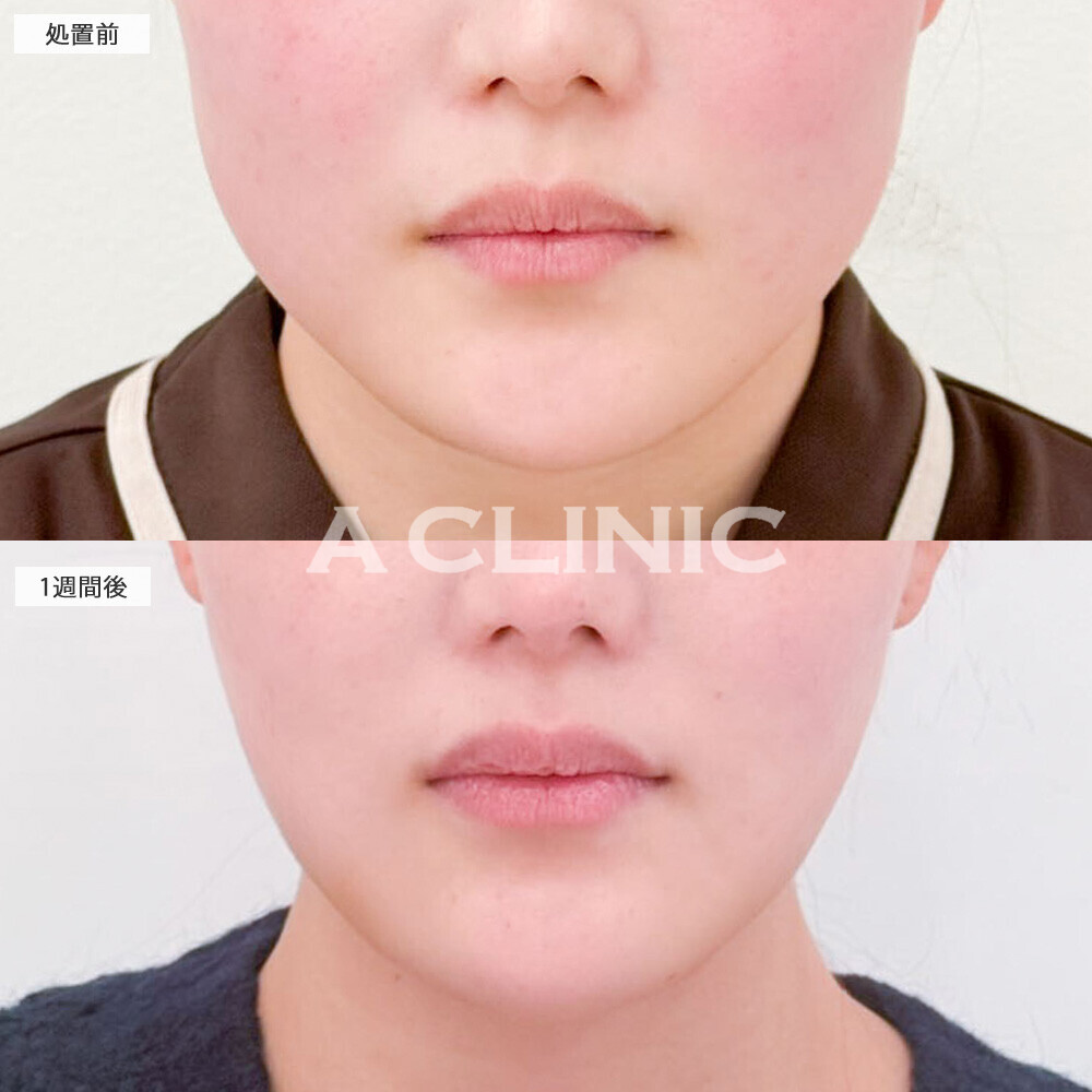 1day小顔脂肪吸引なら術直後でここまでスッキリ！こちら処置前から1週間後の症例です(20代女性)
