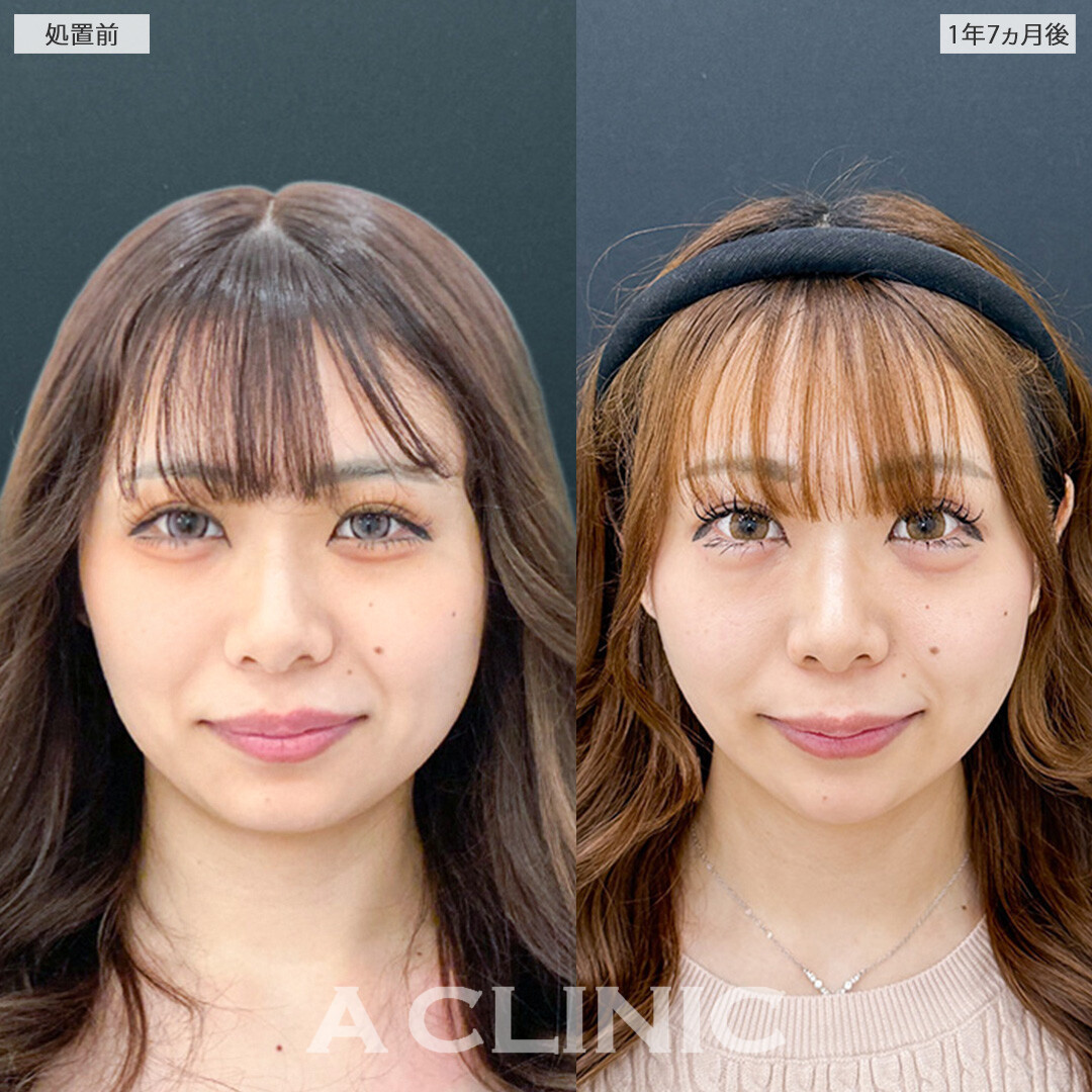 1day小顔脂肪吸引なら時間が経っても美しい小顔をずっとキープ！こちら処置前と1年7ヶ月後の症例です(20代女性)