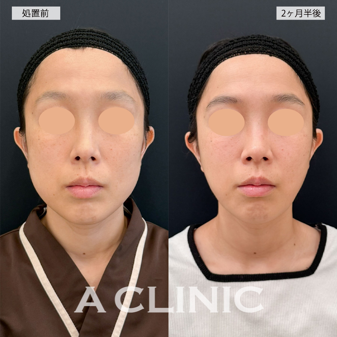 1day小顔脂肪吸引で角ばっていた輪郭が女性らしい卵型の輪郭に！こちら処置前と2ヶ月半後の症例です(30代女性)