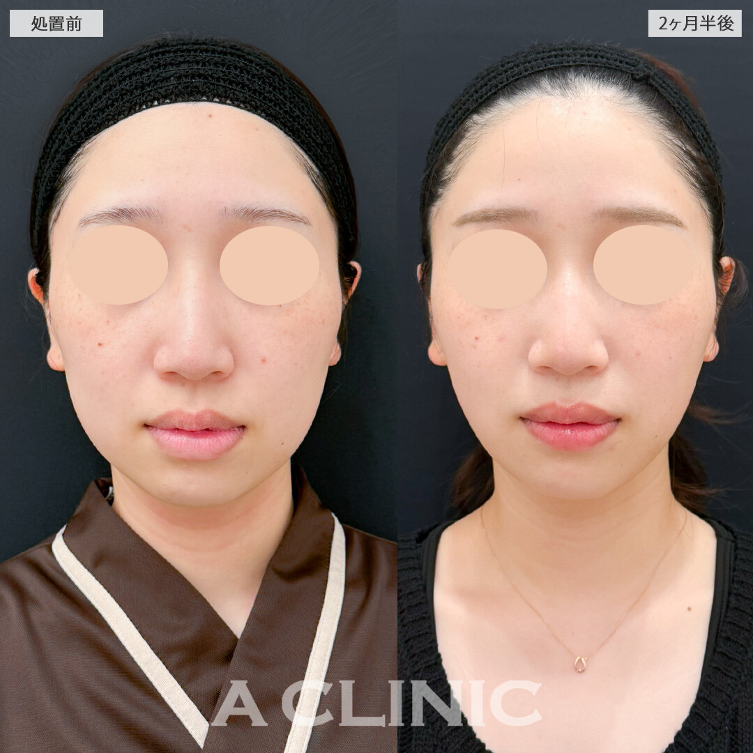 1day小顔脂肪吸引と小顔エラボトックスでスッキリさせつつ自然な仕上がりでお顔のクオリティを上げられます！処置前と2ヶ月半後の症例です(20代女性)