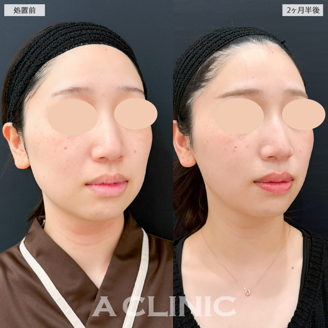 1day小顔脂肪吸引と小顔エラボトックスでスッキリさせつつ自然な仕上がりでお顔のクオリティを上げられます！処置前と2ヶ月半後の症例です(20代女性)