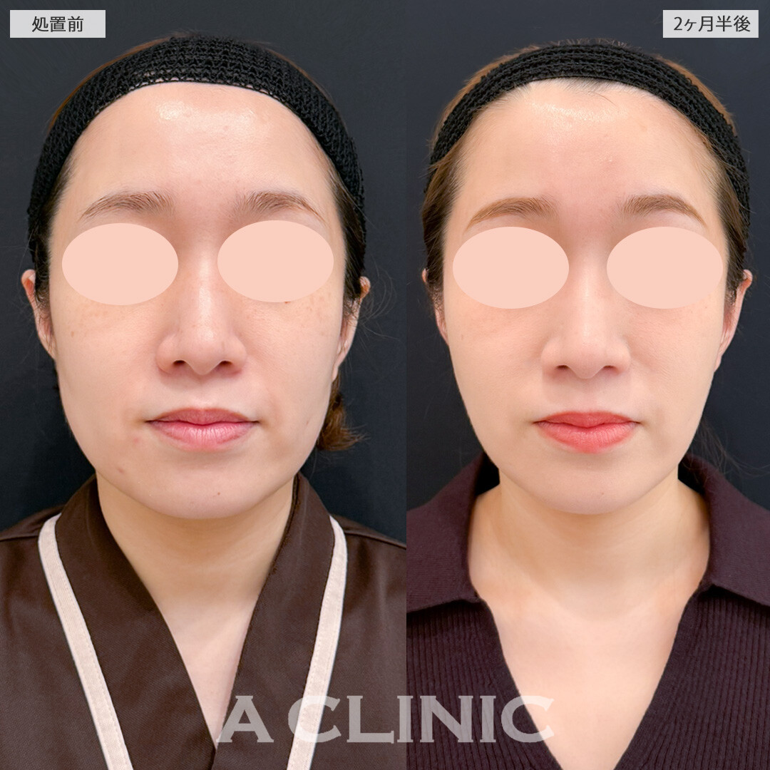 1day小顔脂肪吸引と小顔エラボトックスでもたつきをなくすだけでも一気に若返ります！処置前と2ヶ月半後の症例です(30代女性)