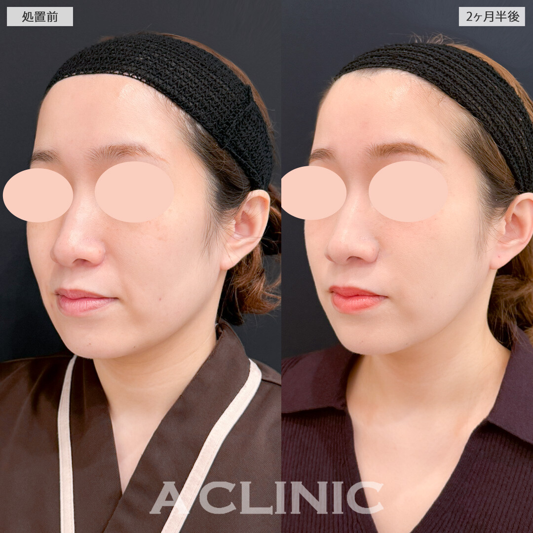1day小顔脂肪吸引と小顔エラボトックスでもたつきをなくすだけでも一気に若返ります！処置前と2ヶ月半後の症例です(30代女性)