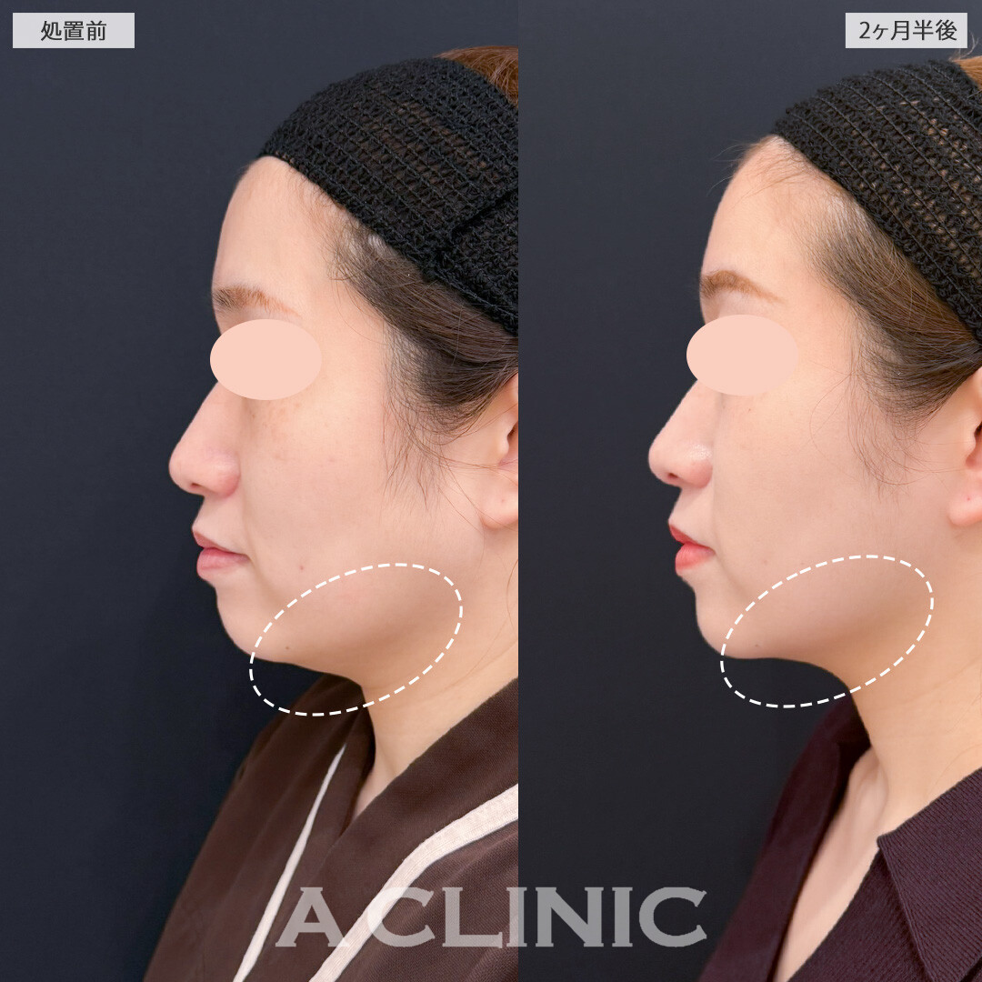1day小顔脂肪吸引と小顔エラボトックスでもたつきをなくすだけでも一気に若返ります！処置前と2ヶ月半後の症例です(30代女性)