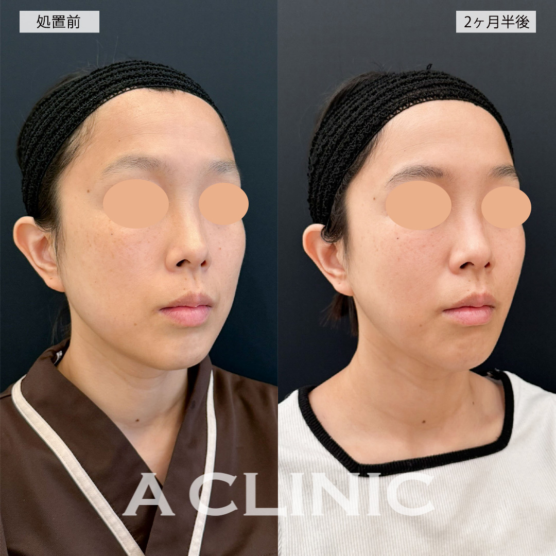 1day小顔脂肪吸引で角ばっていた輪郭が女性らしい卵型の輪郭に！こちら処置前と2ヶ月半後の症例です(30代女性)