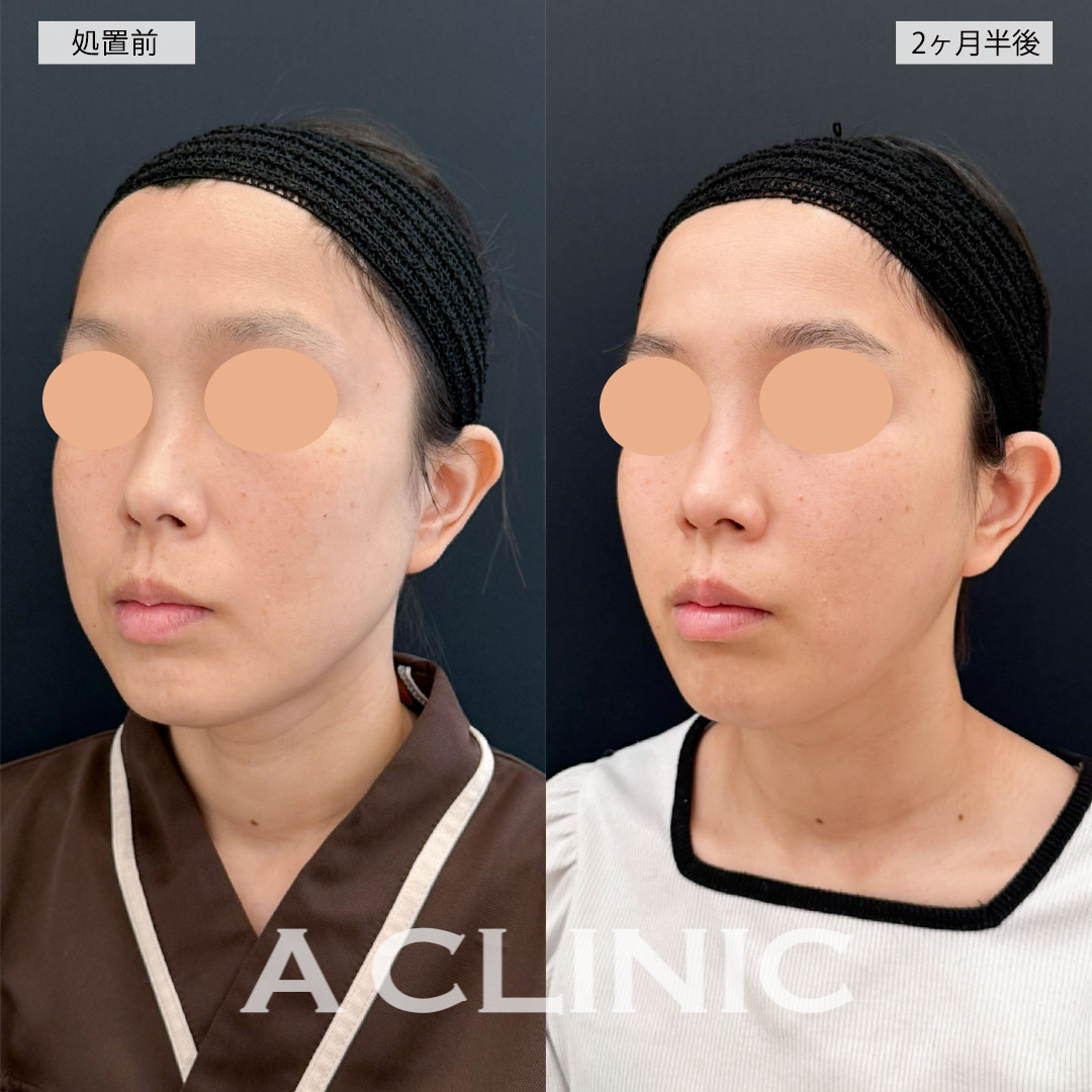 1day小顔脂肪吸引で角ばっていた輪郭が女性らしい卵型の輪郭に！こちら処置前と2ヶ月半後の症例です(30代女性)