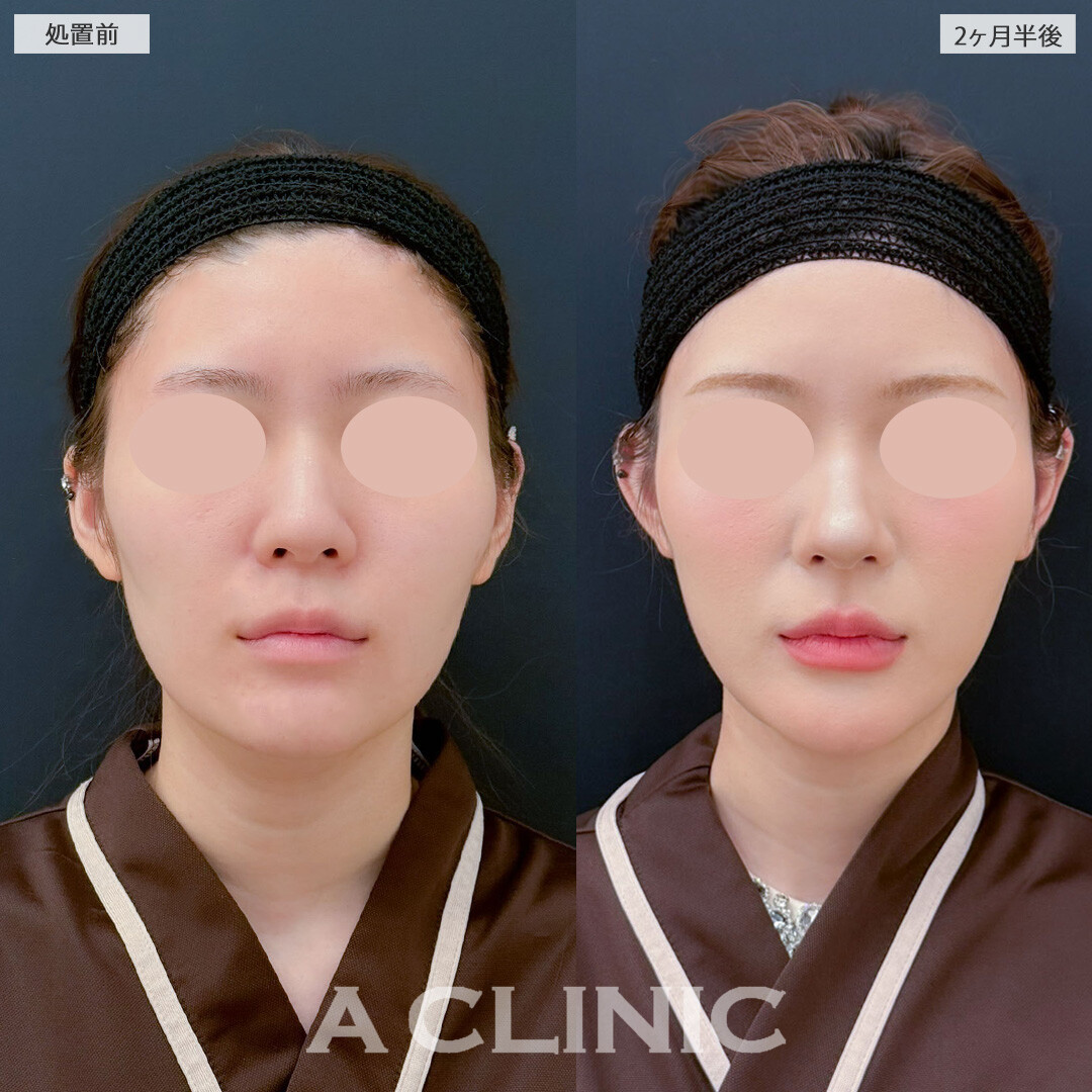 1day小顔脂肪吸引で余分な脂肪を除去しフェイスラインがシュッとスッキリしました！こちら処置前と2ヶ月半後の症例です(20代女性)