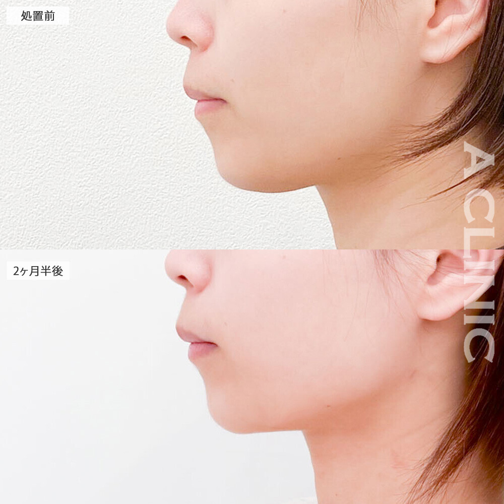 1day小顔脂肪吸引であご下のぷにぷに解消！こちら処置前から2ヶ月半後の症例です(20代女性)