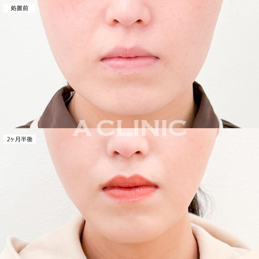 1day小顔脂肪吸引と小顔エラボトックスでお顔の余白がグッと減りました！こちら処置前と2ヶ月半後の症例です(30代女性)