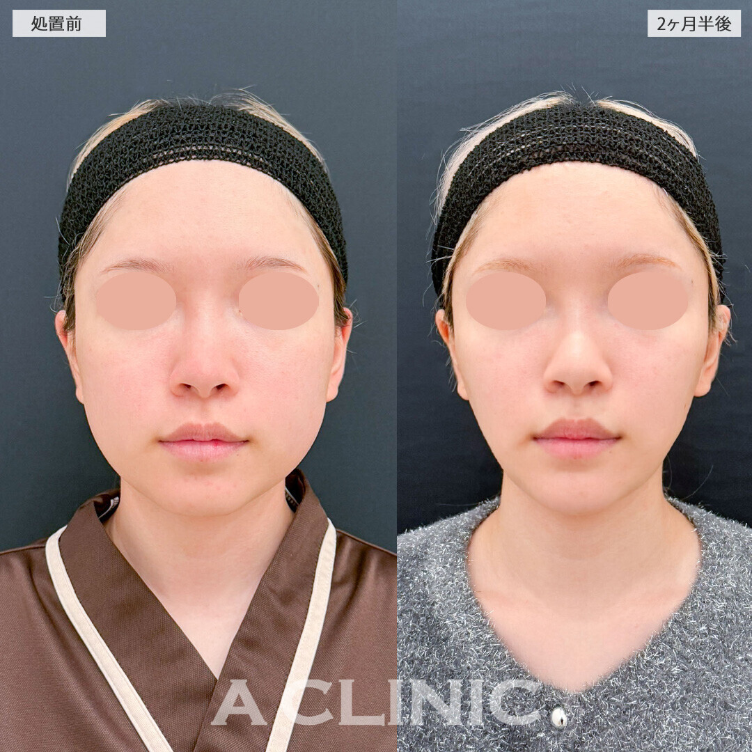 1day小顔脂肪吸引とバッカルファット除去術と小顔エラボトックスでどんな表情でもしっかり小顔に！処置前と2ヶ月半後の症例です(10代女性)
