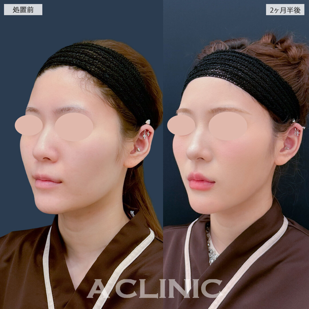 1day小顔脂肪吸引で余分な脂肪を除去しフェイスラインがシュッとスッキリしました！こちら処置前と2ヶ月半後の症例です(20代女性)