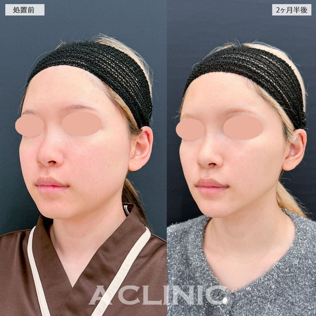 1day小顔脂肪吸引とバッカルファット除去術と小顔エラボトックスでどんな表情でもしっかり小顔に！処置前と2ヶ月半後の症例です(10代女性)