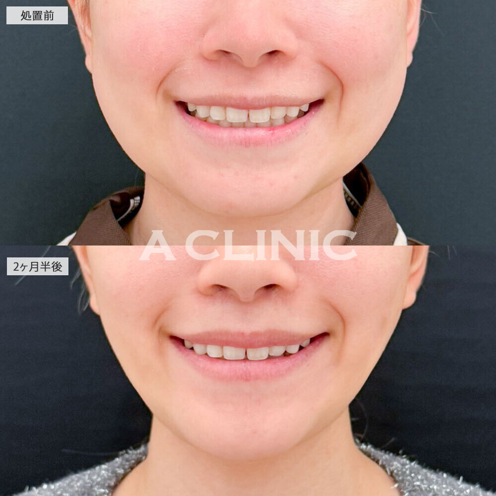 1day小顔脂肪吸引とバッカルファット除去術と小顔エラボトックスでどんな表情でもしっかり小顔に！処置前と2ヶ月半後の症例です(10代女性)