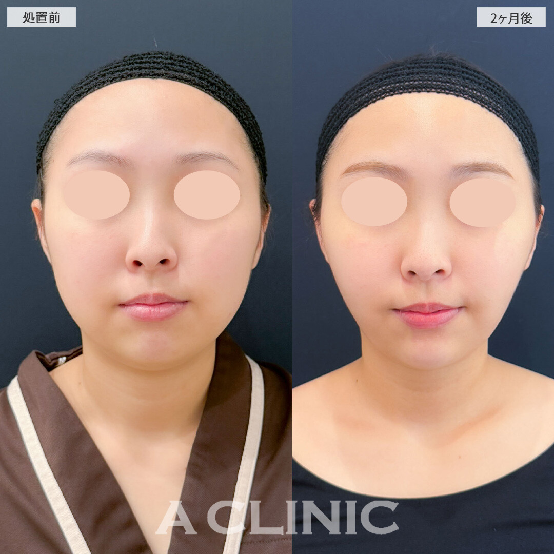 1day小顔脂肪吸引とバッカルファット除去術と小顔エラボトックスで余分な脂肪を除去し自然なスッキリフェイスになりました！処置前と2ヶ月後の症例です(20代女性)