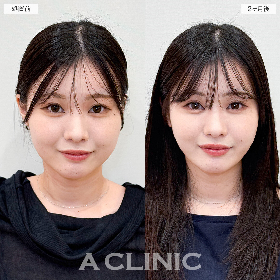 1day小顔脂肪吸引で部分痩せが叶いました！処置前と2ヶ月後の症例です(20代女性)